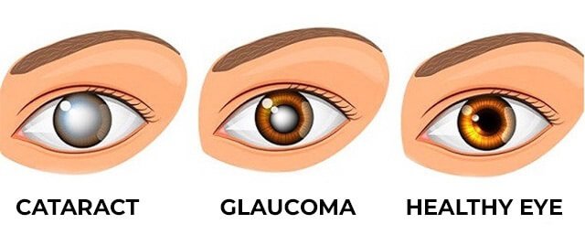 Glaucoma