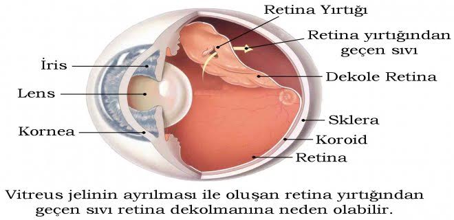 Retina Dekolmani Ozel Karsiyaka Goz Hastanesi