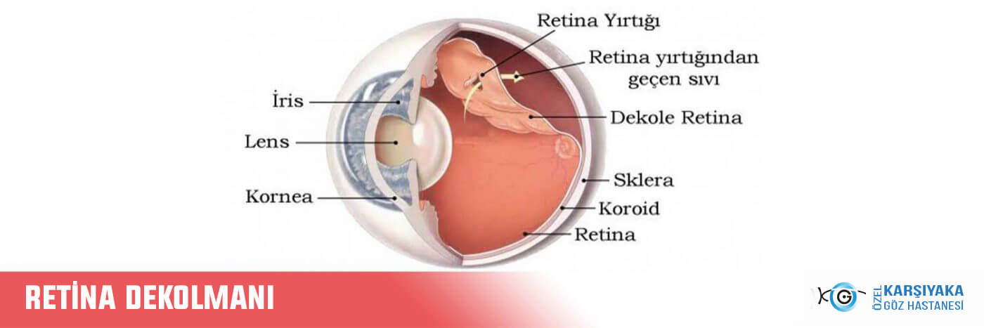 Retina Dekolmani Ozel Karsiyaka Goz Hastanesi