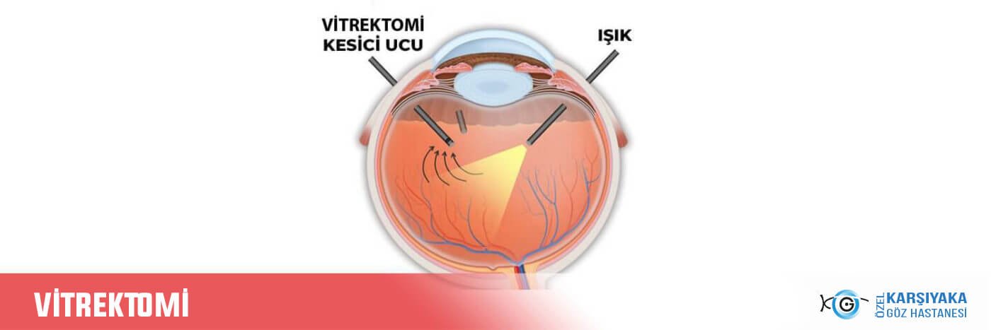 Vitrektomi Ozel Karsiyaka Goz Hastanesi